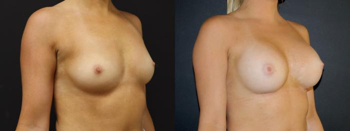 Before & After Breast Augmentation Case 105 Right Oblique View in Charleston, SC