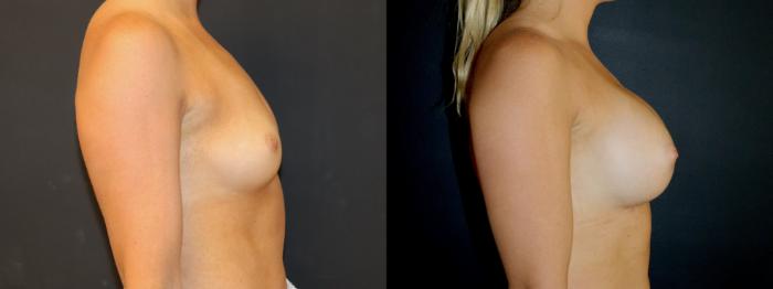Before & After Breast Augmentation Case 105 Right Side View in Charleston, SC