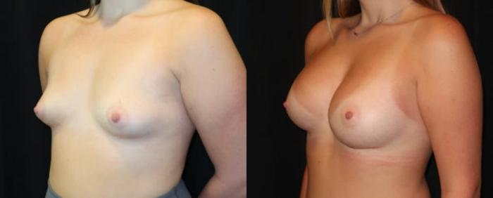Before & After Breast Augmentation Case 11 Left Oblique View in Charleston, SC