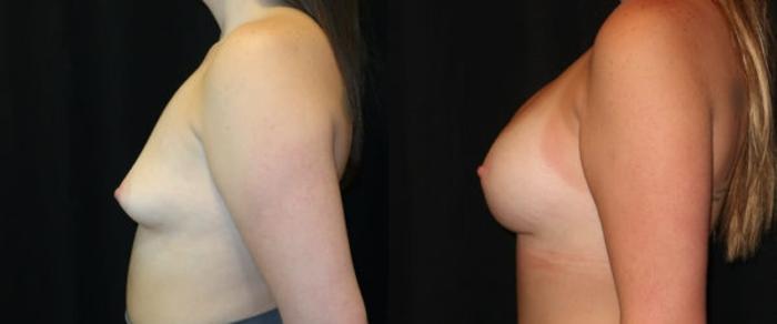 Before & After Breast Augmentation Case 11 Left Side View in Charleston, SC