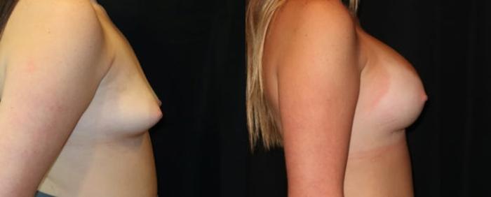 Before & After Breast Augmentation Case 11 Right Side View in Charleston, SC