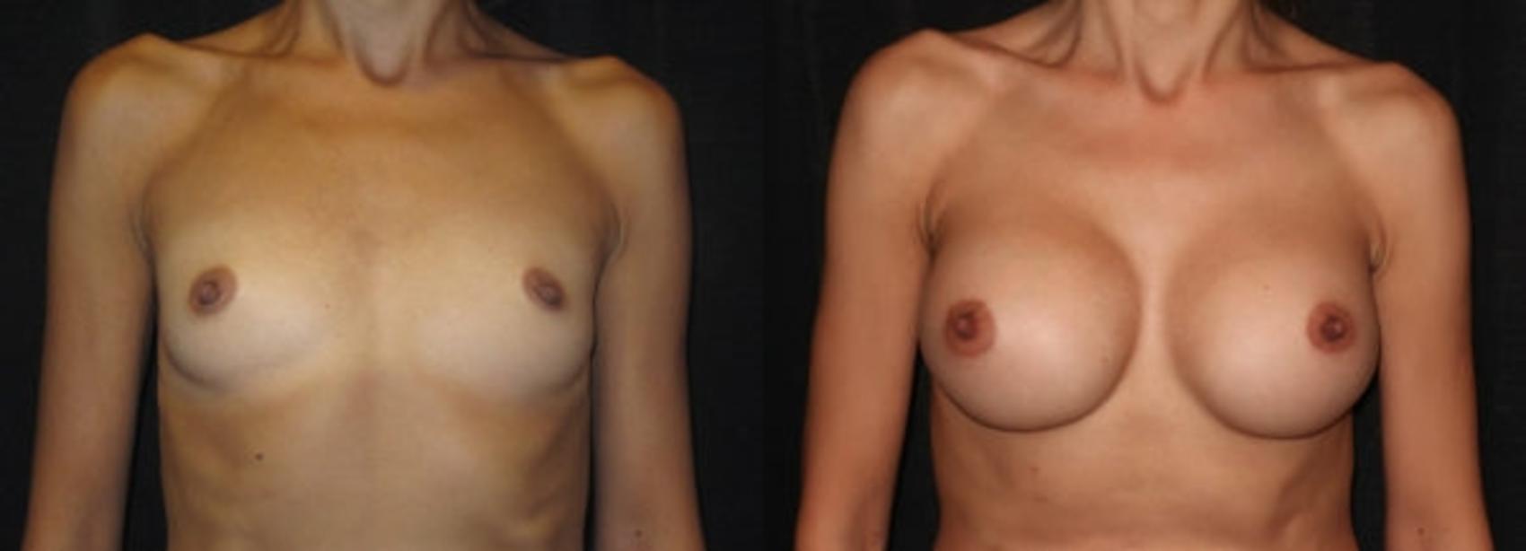 Before & After Breast Augmentation Case 12 Front View in Charleston, SC