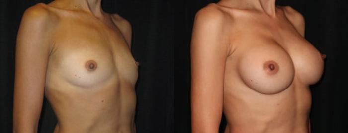 Before & After Breast Augmentation Case 12 Right Oblique View in Charleston, SC