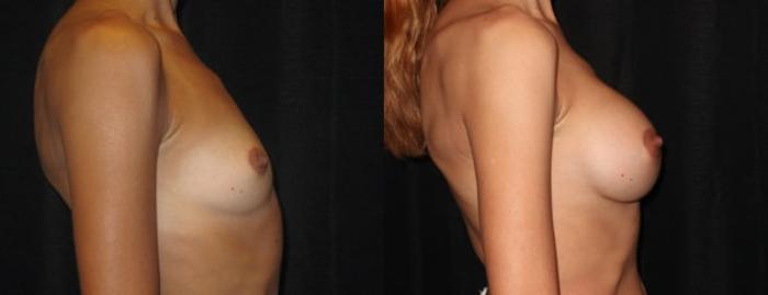 Before & After Breast Augmentation Case 12 Right Side View in Charleston, SC