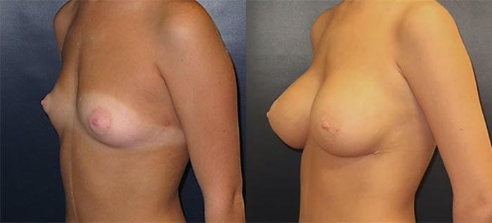 Before & After Breast Augmentation Case 13 Left Oblique View in Charleston, SC