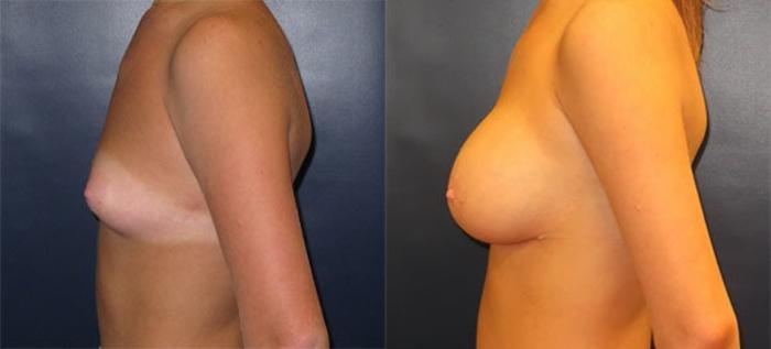 Before & After Breast Augmentation Case 13 Left Side View in Charleston, SC