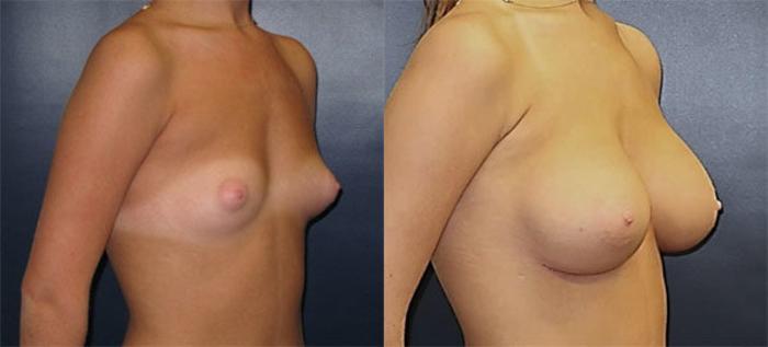 Before & After Breast Augmentation Case 13 Right Oblique View in Charleston, SC