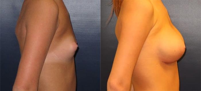 Before & After Breast Augmentation Case 13 Right Side View in Charleston, SC