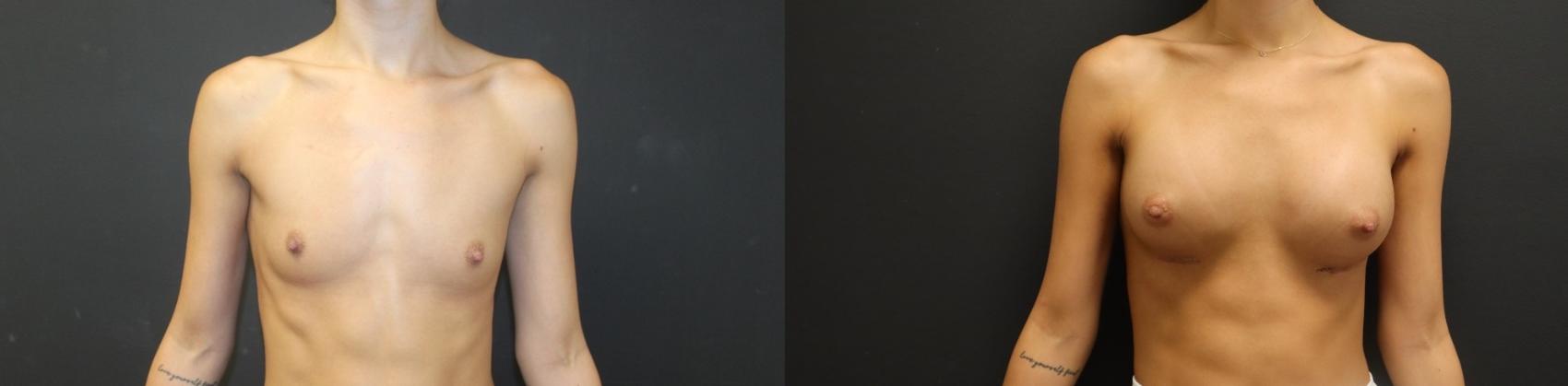 Before & After Breast Augmentation Case 135 Front View in Charleston, SC