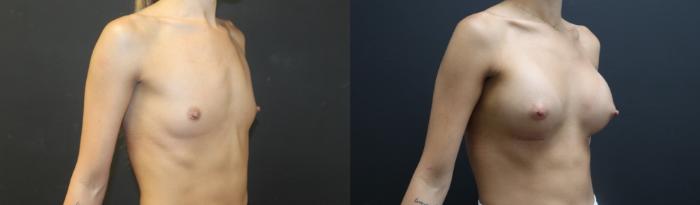 Before & After Breast Augmentation Case 135 Right Oblique View in Charleston, SC