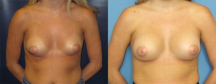 Before & After Breast Augmentation Case 14 Front View in Charleston, SC