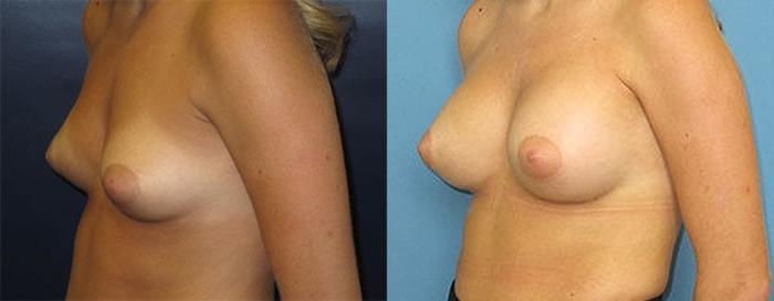 Before & After Breast Augmentation Case 14 Left Oblique View in Charleston, SC