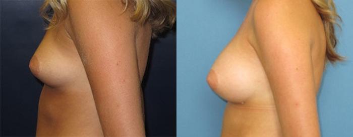 Before & After Breast Augmentation Case 14 Left Side View in Charleston, SC