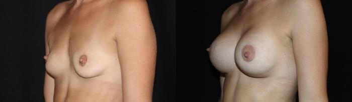 Before & After Breast Augmentation Case 149 Left Oblique View in Charleston, SC