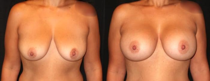 Before & After Breast Augmentation Case 15 Front View in Charleston, SC