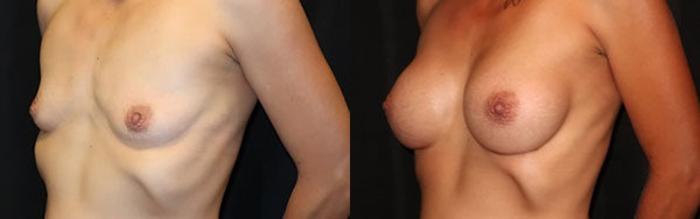 Before & After Breast Augmentation Case 16 Left Oblique View in Charleston, SC
