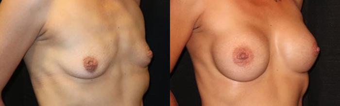 Before & After Breast Augmentation Case 16 Right Oblique View in Charleston, SC