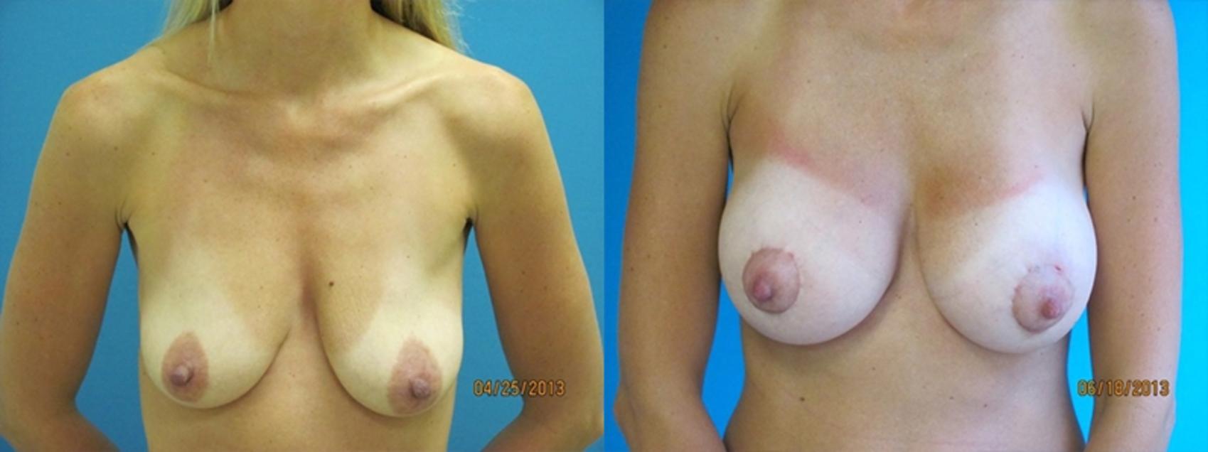 Before & After Breast Augmentation Case 2 Front View in Charleston, SC