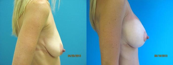 Before & After Breast Augmentation Case 2 Right Side View in Charleston, SC
