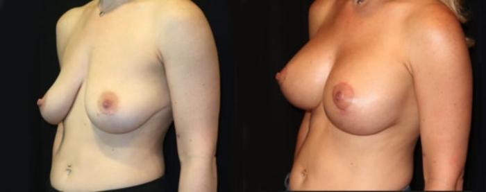 Before & After Breast Augmentation Case 23 Left Oblique View in Charleston, SC