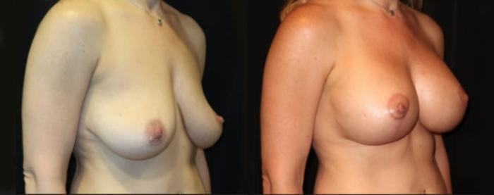 Before & After Breast Lift Case 23 Right Oblique View in Charleston, SC