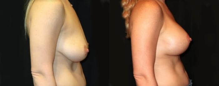 Before & After Breast Augmentation Case 23 Right Side View in Charleston, SC
