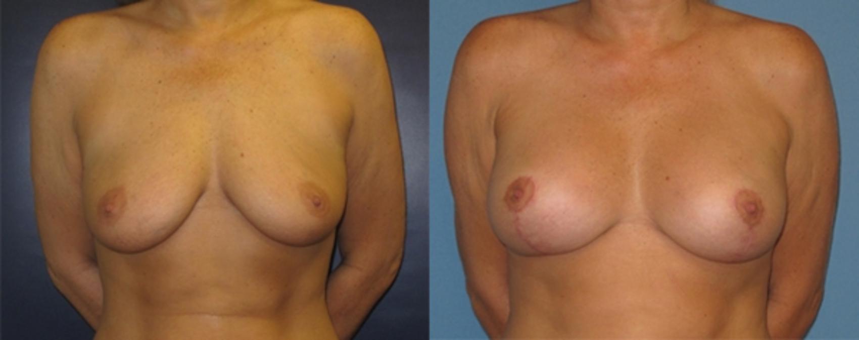 Before & After Breast Augmentation Case 24 Front View in Charleston, SC