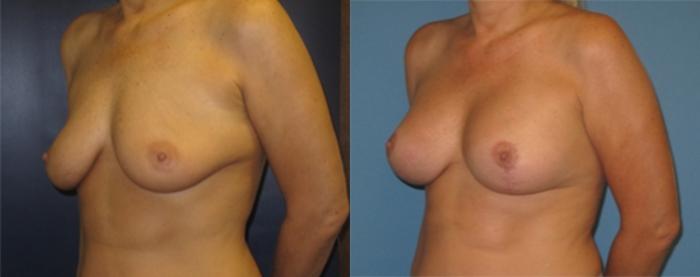 Before & After Breast Augmentation Case 24 Left Oblique View in Charleston, SC