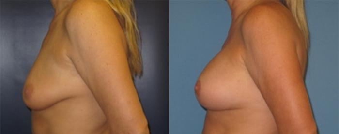 Before & After Breast Augmentation Case 24 Left Side View in Charleston, SC