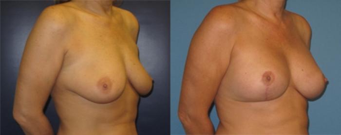 Before & After Breast Lift Case 24 Right Oblique View in Charleston, SC