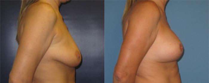 Before & After Breast Lift Case 24 Right Side View in Charleston, SC