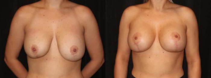 Before & After Breast Augmentation Case 25 Front View in Charleston, SC