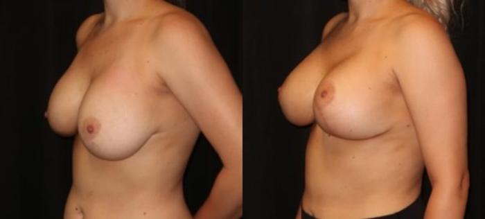 Before & After Breast Augmentation Case 25 Left Oblique View in Charleston, SC