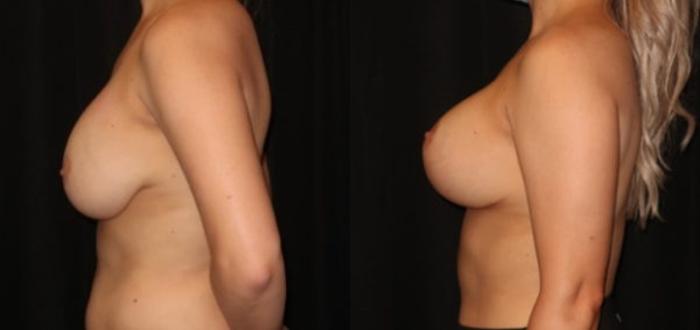 Before & After Breast Augmentation Case 25 Left Side View in Charleston, SC