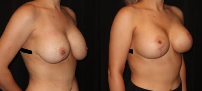Before & After Breast Lift Case 25 Right Oblique View in Charleston, SC