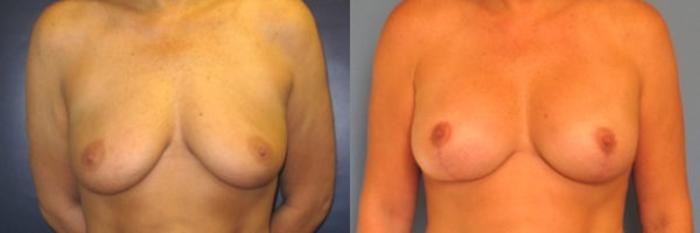 Before & After Breast Augmentation Case 26 Front View in Charleston, SC