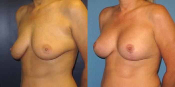 Before & After Breast Augmentation Case 26 Left Oblique View in Charleston, SC