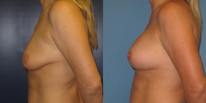 Before & After Breast Augmentation Case 26 Left Side View in Charleston, SC