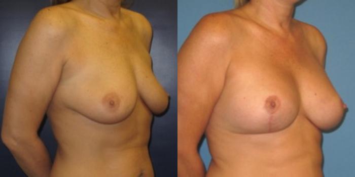 Before & After Breast Lift Case 26 Right Oblique View in Charleston, SC