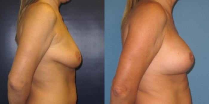 Before & After Breast Lift Case 26 Right Side View in Charleston, SC
