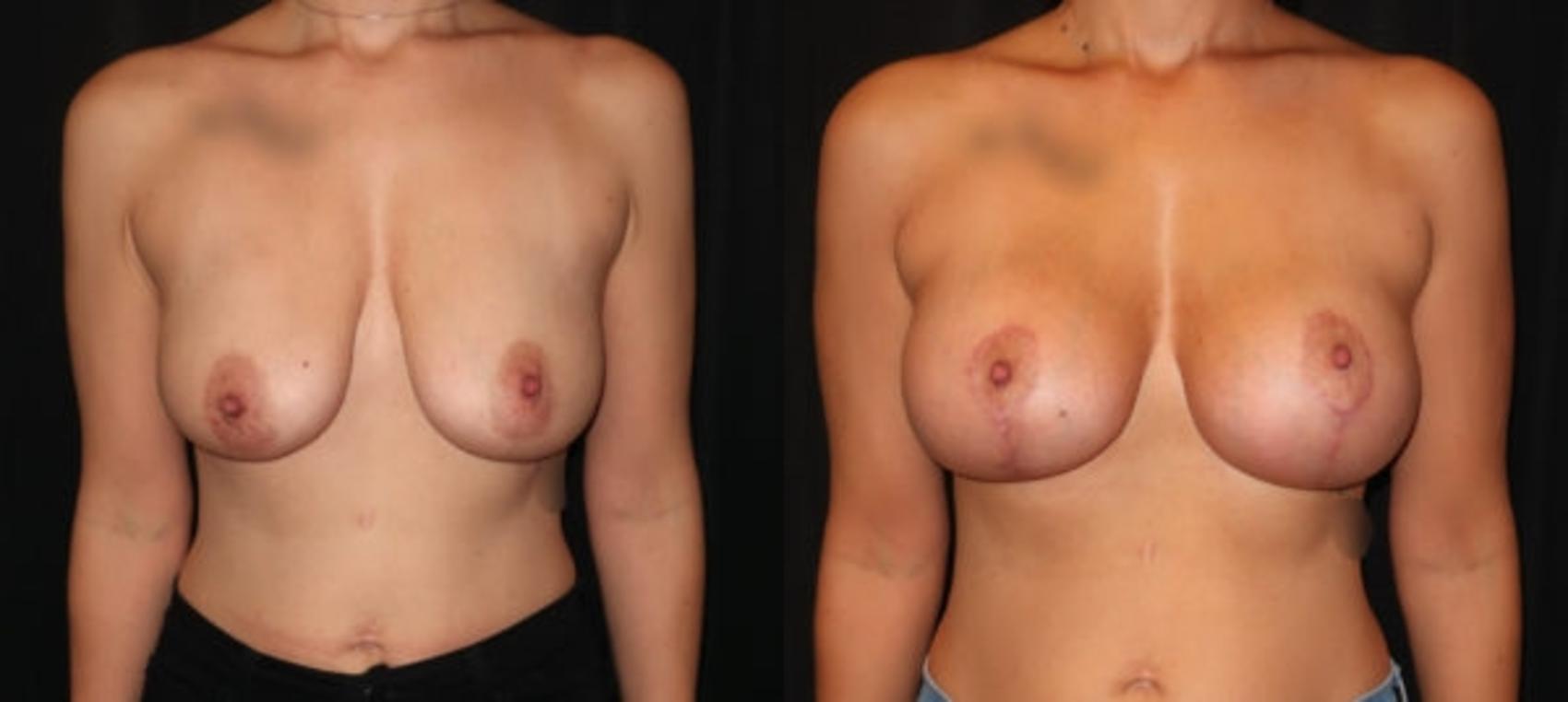 Before & After Breast Augmentation Case 27 Front View in Charleston, SC