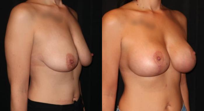 Before & After Breast Augmentation Case 27 Right Oblique View in Charleston, SC