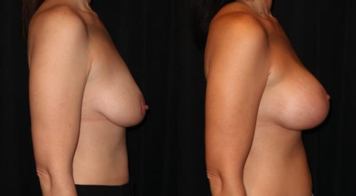 Before & After Breast Lift Case 27 Right Side View in Charleston, SC