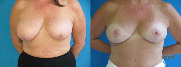 Before & After Breast Augmentation Case 8 Front View in Charleston, SC