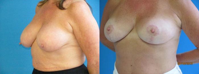 Before & After Breast Augmentation Case 8 Left Oblique View in Charleston, SC