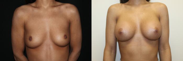 Before & After Breast Augmentation Case 80 Front View in Charleston, SC
