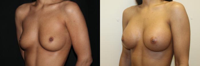 Before & After Breast Augmentation Case 80 Left Oblique View in Charleston, SC