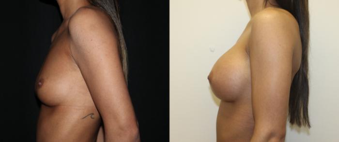 Before & After Breast Augmentation Case 80 Left Side View in Charleston, SC