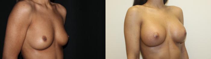 Before & After Breast Augmentation Case 80 Right Oblique View in Charleston, SC