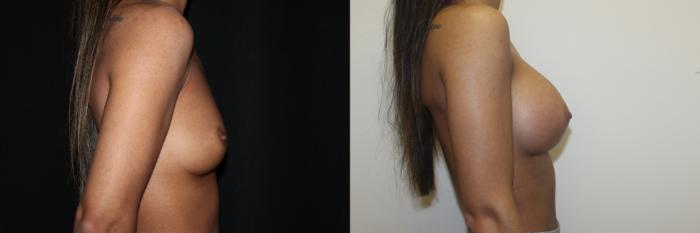Before & After Breast Augmentation Case 80 Right Side View in Charleston, SC